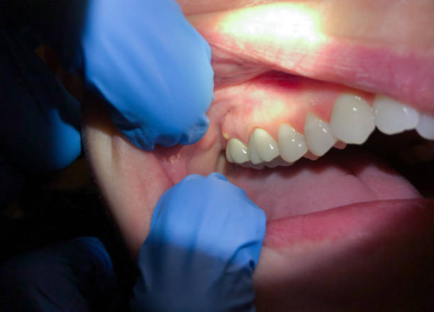 Best Emergency Root Canal Treatment in Pembroke, VA
